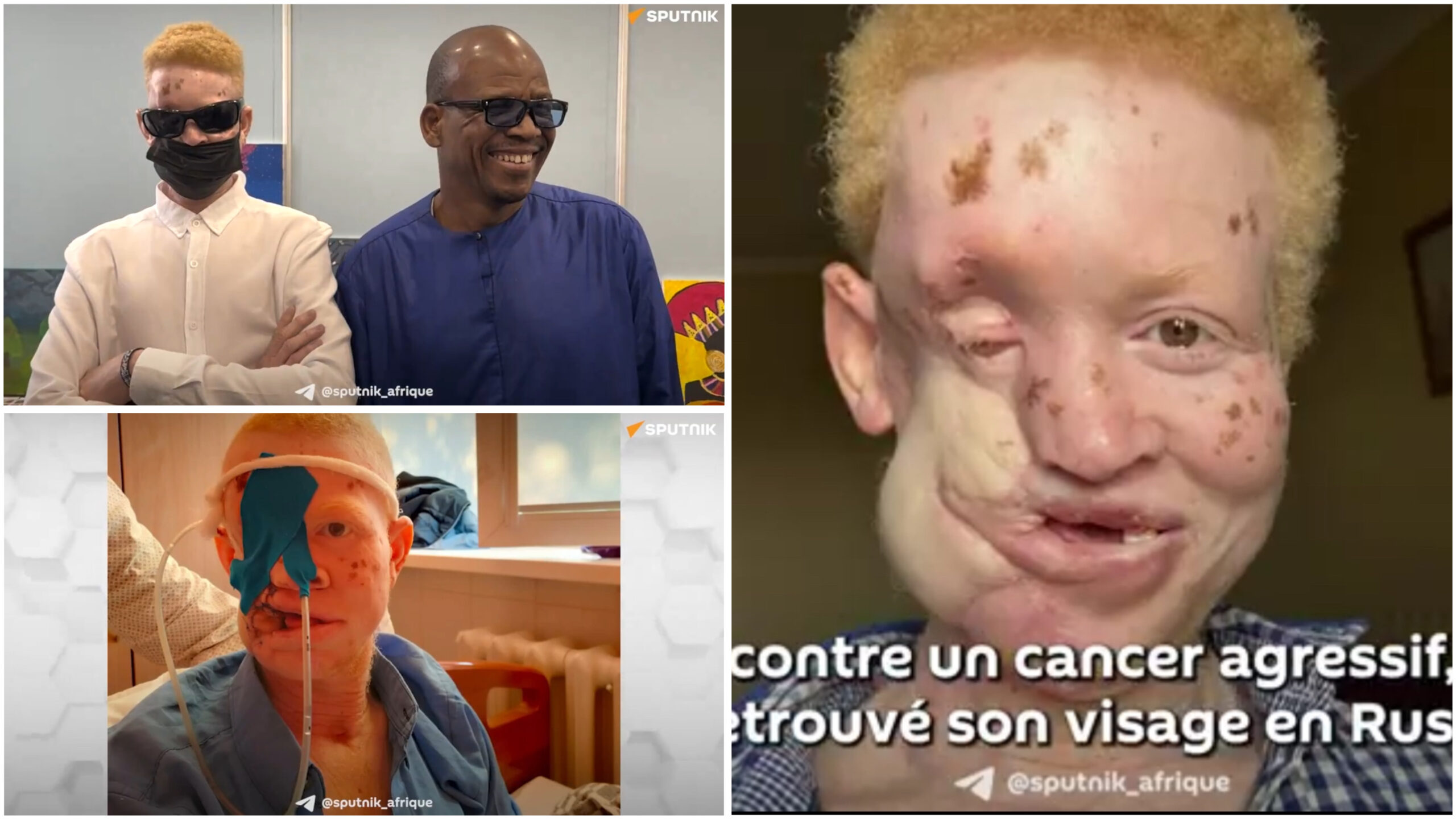 Le jeune Sénégalais Khadim défiguré par une maladie retrouve un visage en Russie (video)
