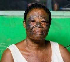 Dépigmentation des parties intimes aux baumes : le phénomène qui fait fureur à Dakar