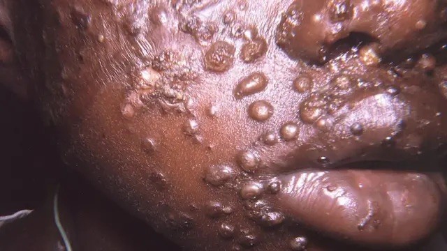 Mpox : Le Monde est-il Face à une Nouvelle Menace Pandémique ?